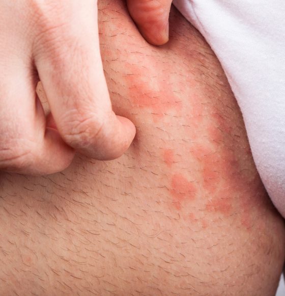 Eczema groin atopic dermatitis symptom of skin texture